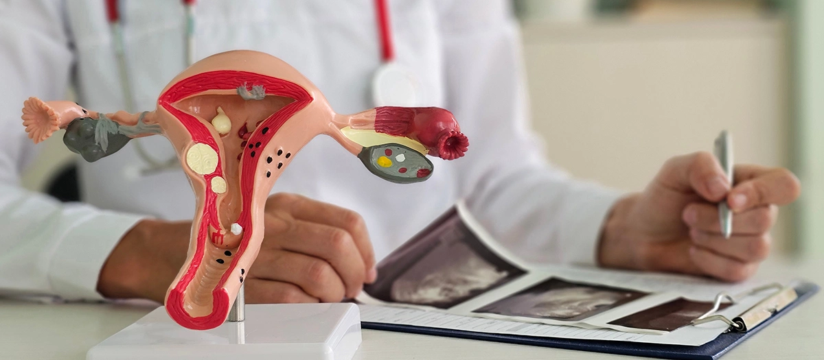 Doctor reviewing an ovarian cyst report with a female reproductive anatomy model during a consultation. 
