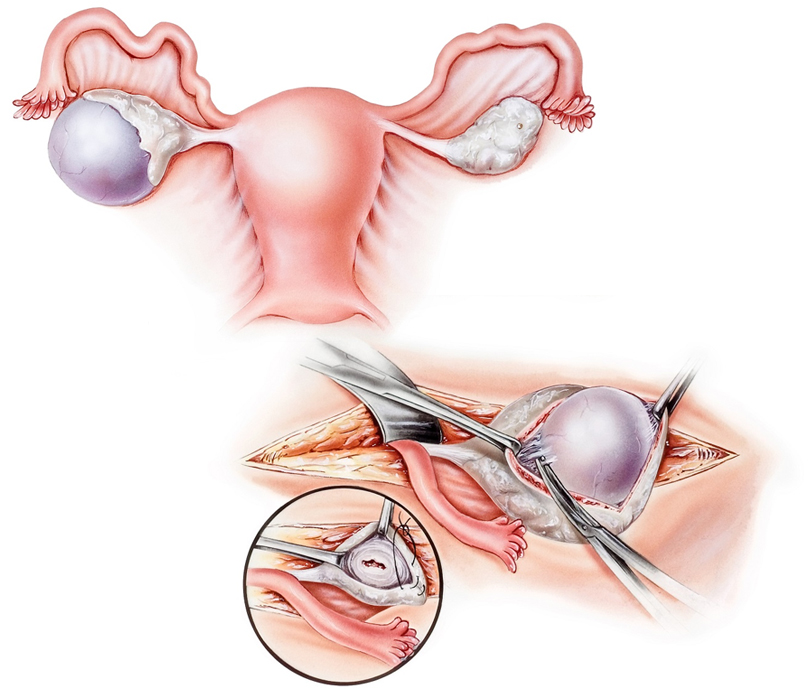 Ovarian Cyst Surgery